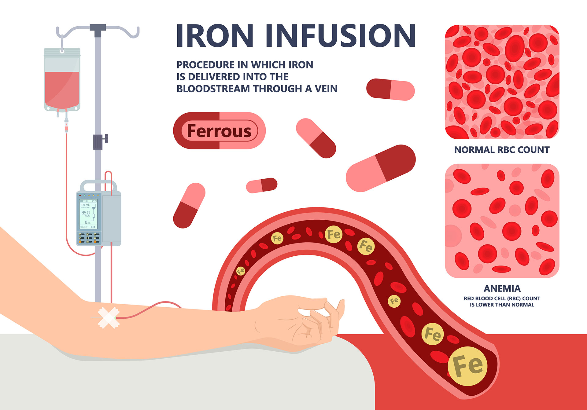 Eiseninfusion wird erklärt