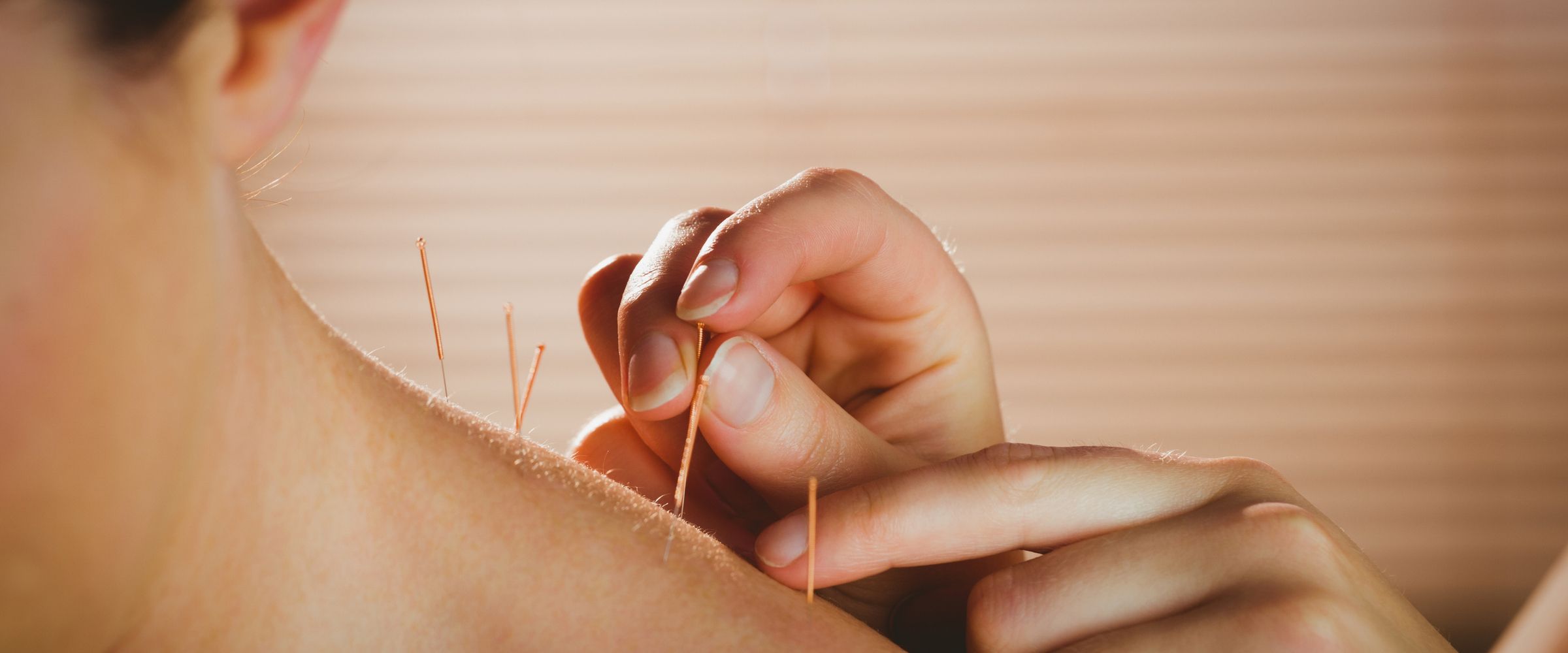 Akupunkturnadeln stecken in der Haut